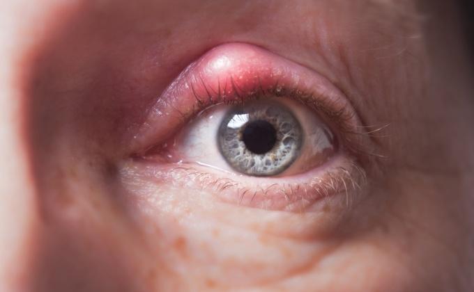Ulciorul la ochi – De ce trebuie să alegi tratamentul oftalmologic în cazul apariției acestuia