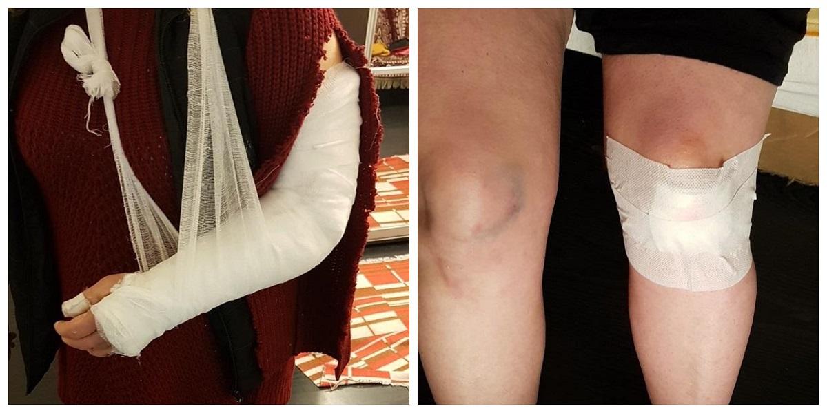 În loc de ghips, medicii din Cluj i-au fixat femeii mâna ruptă cu o bucată de carton