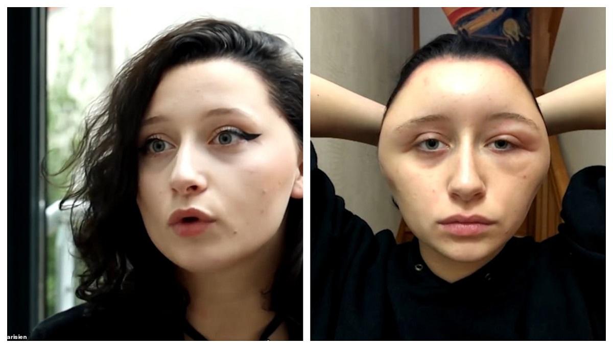 Capul unei tinere s-a deformat din cauza vopselei de păr