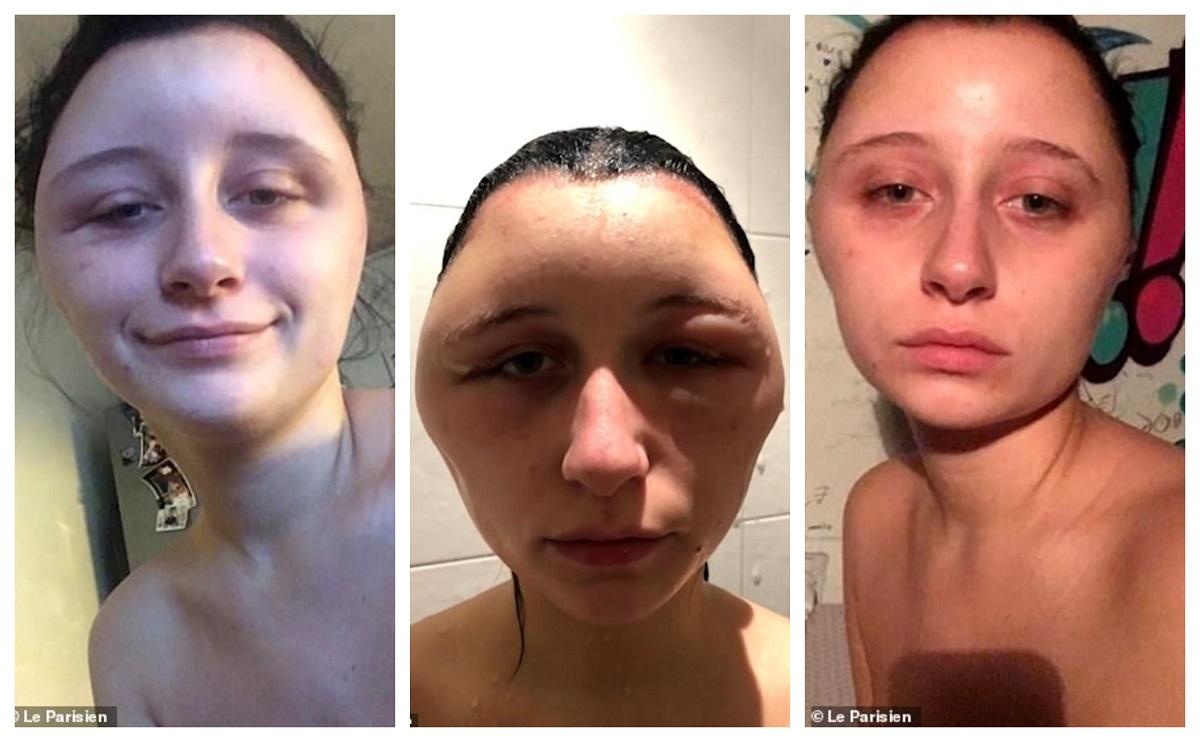 Tânăra a suferit o reacţie alergică la vopseaua de păr