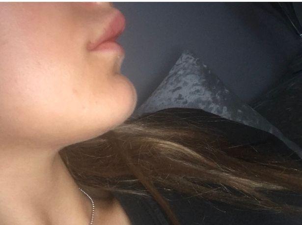 Operație nereușită la buze