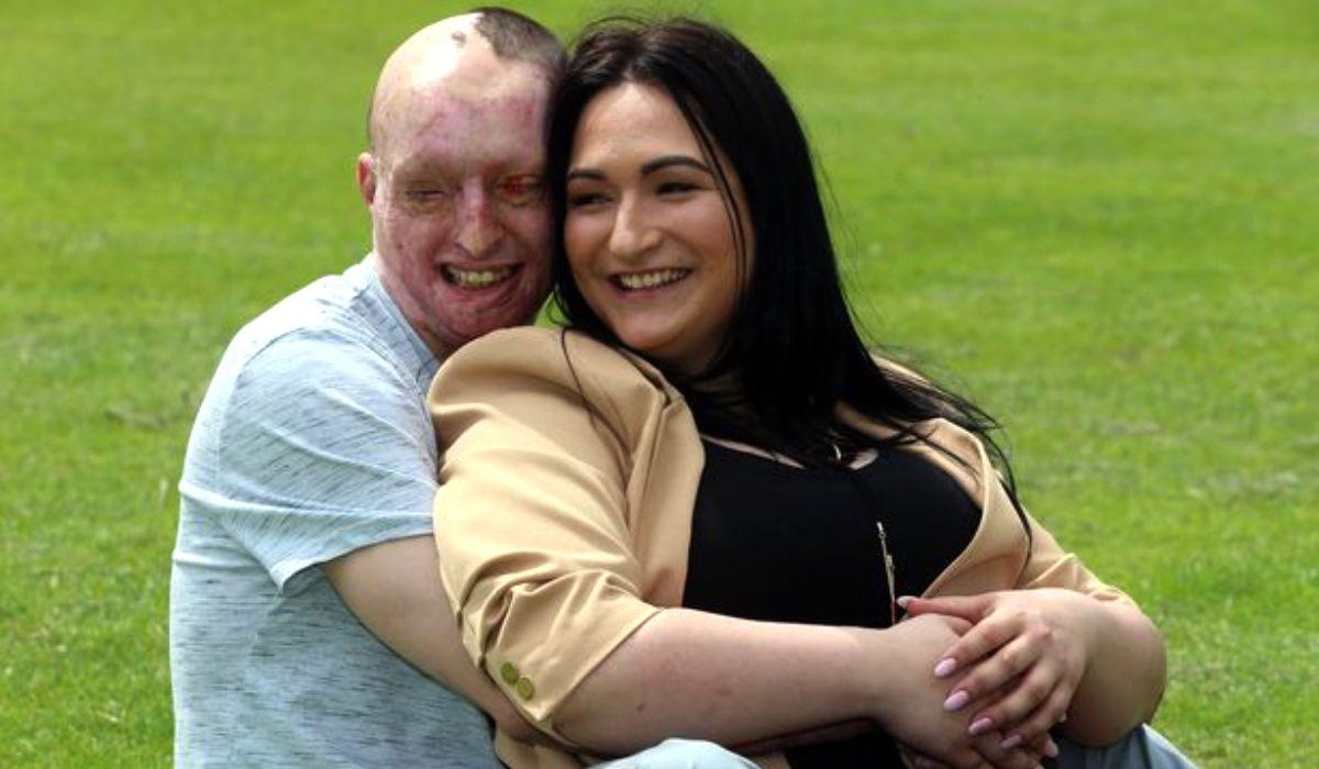 Românul desfigurat cu acid de logodnică, în Anglia, şi-a găsit sufletul pereche