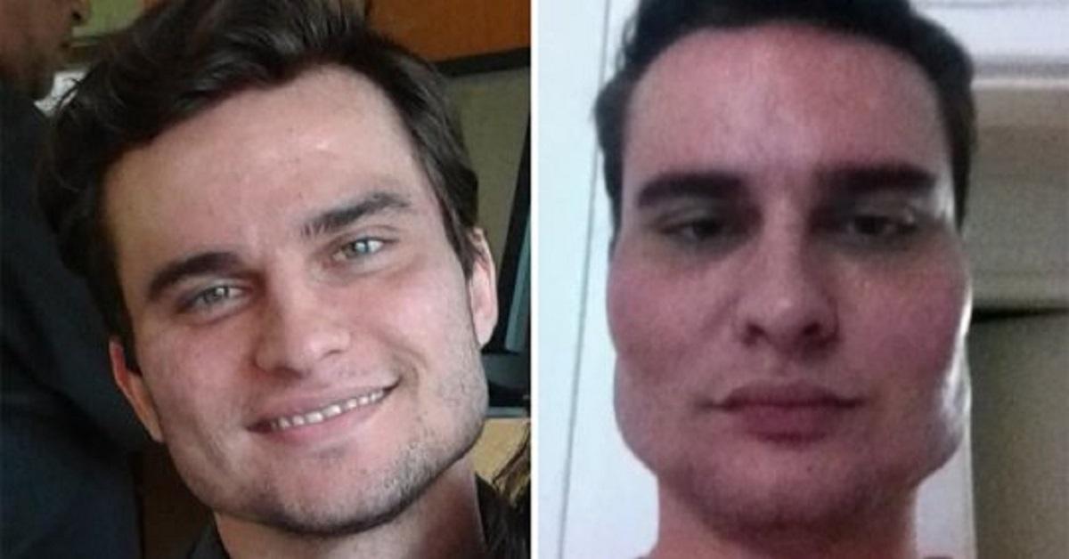 Bărbat lăsat cu chipul deformat, după o intervenție estetică