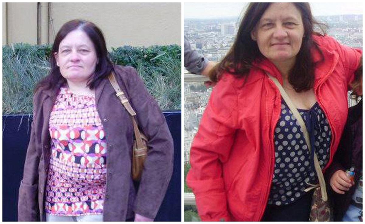 Adele Barbour Medicii au supus-o intervenţiei de cezariană, crezând că e însărcinată