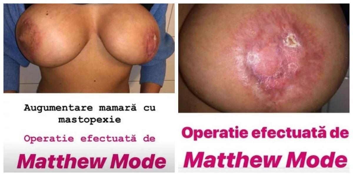 Pacientă cu sânii mutilaţi de falsul medic italian Matteo Politi