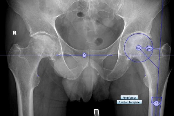 Radiografia unei operații la șold