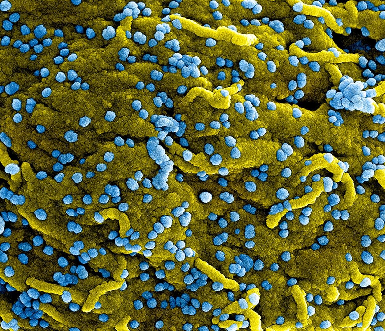 Cum arată o tulpină de coronavirus la microscop