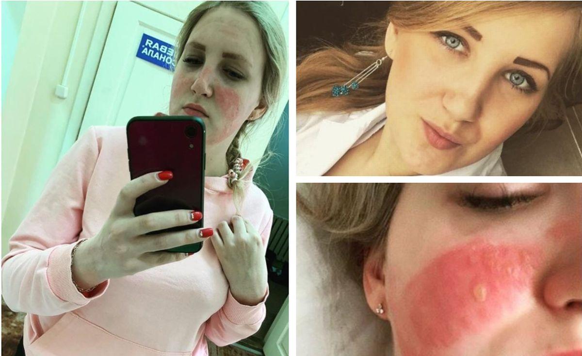 Olga Ovinnikova a ajuns la spitalul de arși din cauza măștilor dezinfectate cu clor