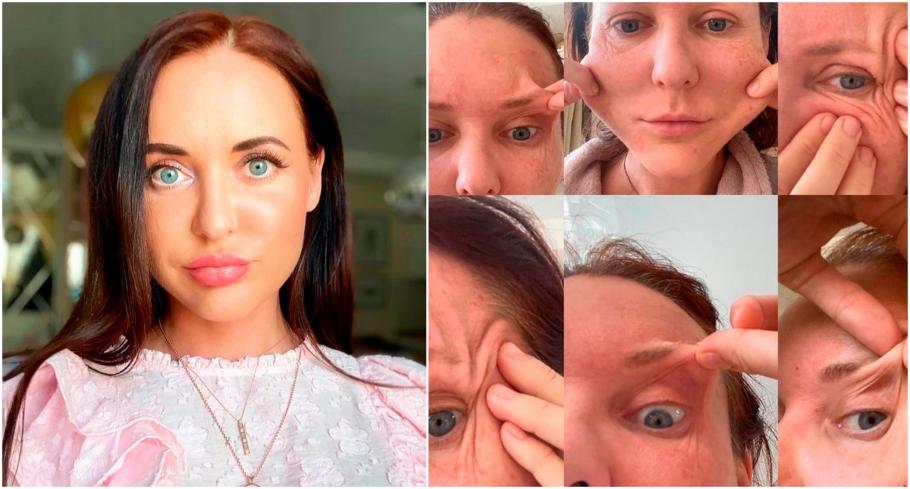 O femeie, care voia să arate mai tânără pentru fostul iubit, a rămas mutilată pe viaţă după un tratament cosmetic O femeie, care voia să arate mai tânără pentru fostul iubit, a rămas mutilată pe viaţă după un tratament cosmetic