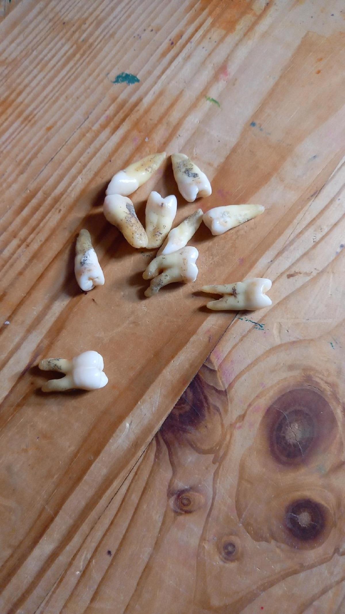 Dinţii pe care şi i-a scos femeia în cei trei ani