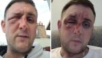 Un bărbat a ajuns la spital cu arsuri grave pe față, după ce a testat în bucătărie un truc viral pe Tiktok, în Scoția