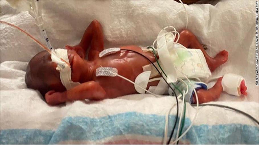 "Cel mai prematur" bebeluș din lume s-a născut la 21 de săptămâni și o zi, în SUA. Bebelușul cântărea doar 420g "Cel mai prematur" bebeluș din lume s-a născut la 21 de săptămâni și o zi, în SUA. Bebelușul cântărea doar 420g