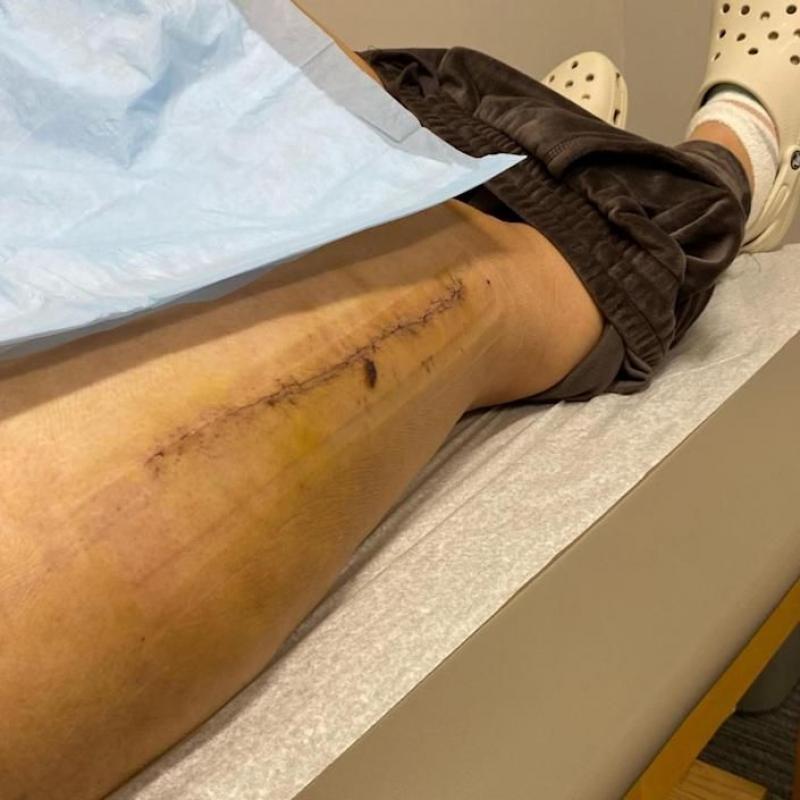 O tânără de 23 de ani aproape că și-a pierdut un picior după un antrenament intens de spinning, în SUA