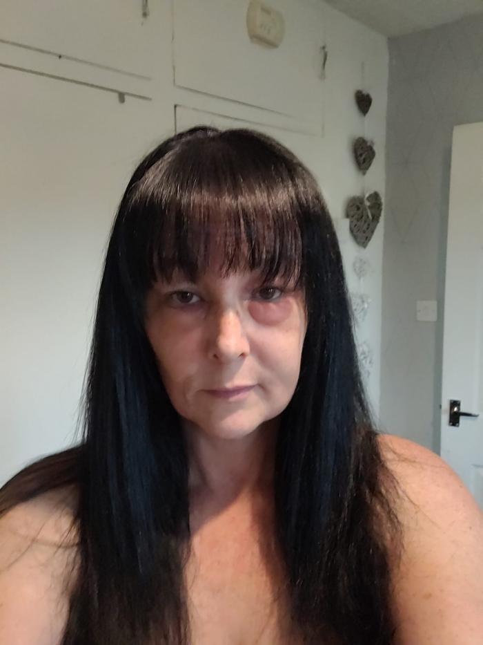 O mamă de 41 de ani din Anglia a ajuns de nerecunoscut, după ce a făcut o reacţie alergică oribilă la vopseaua de păr