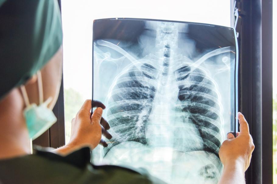 rază la plămâni un medic care examinează o rază la plămâni