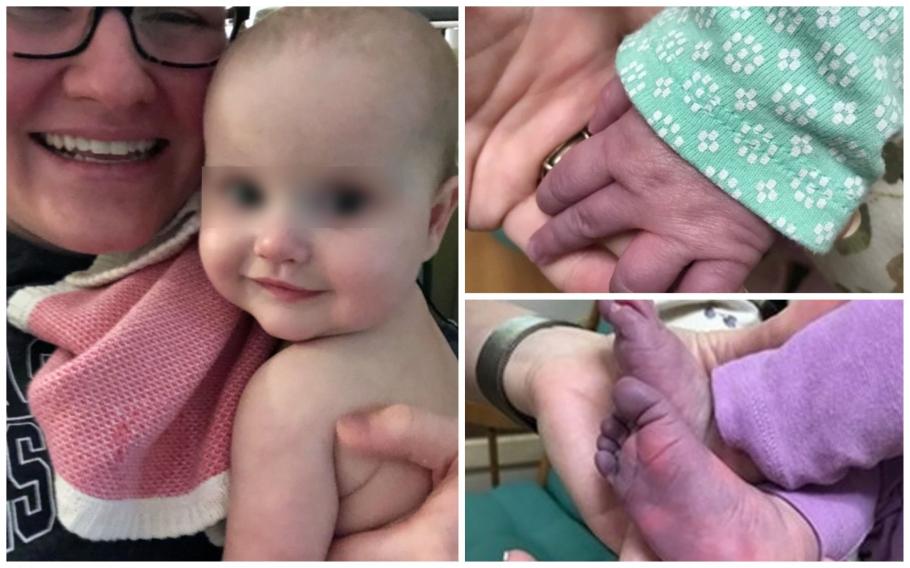 Mâinile și picioarele unei fetițe de cinci luni au devenit albastre, la câteva zile după infecția cu Covid-19 Mâinile și picioarele unei fetițe de cinci luni au devenit albastre, la câteva zile după infecția cu Covid-19