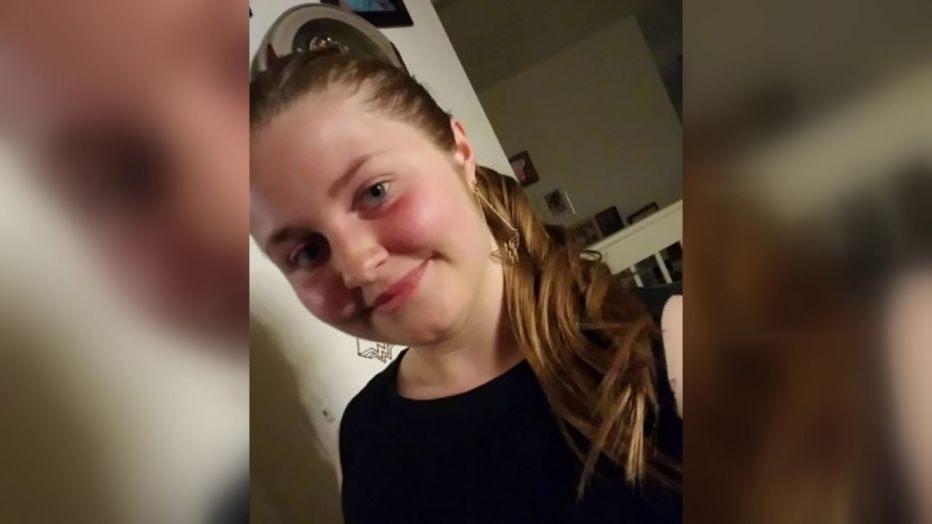 Emma Burkey a început să aibă convulsii la o săptămână după vaccinarea cu Johnson & Johnson Emma Burkey a început să aibă convulsii la o săptămână după vaccinarea cu Johnson & Johnson