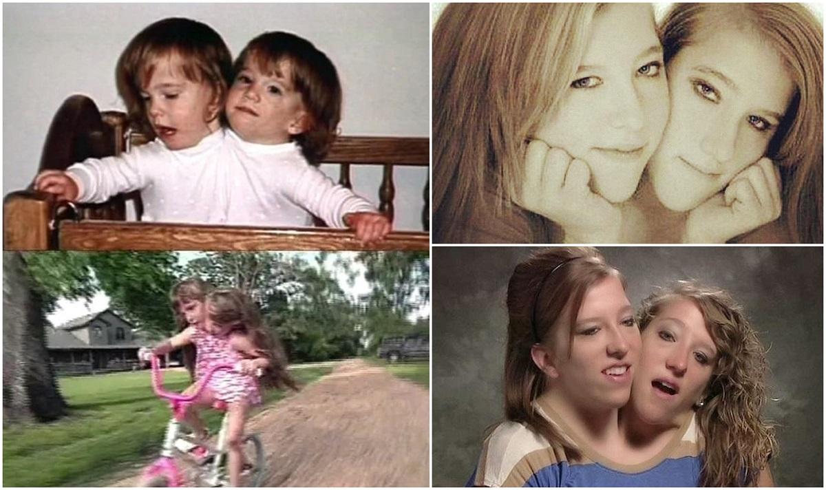 Conjoined twins Abigail and Brittany Hensel — Steemit