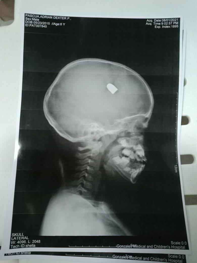Adrian Lexter Pascua a fost operat pe creier pentru a fi scos glonțul care l-a lovit