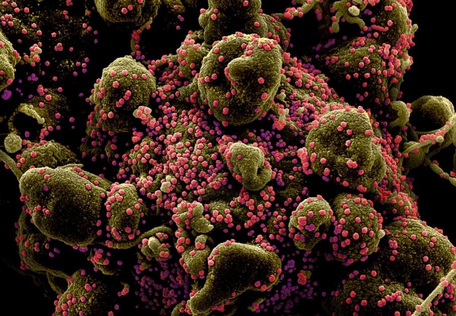 O proteină găsită pe suprafața celulelor infectate cu coronavirus împiedică sistemul imunitar să acționeze. ”Un factor major asociat cu forma severă de Covid-19” Celulă infectată cu particule de coronavirus