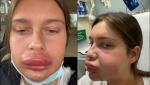O femeie care a încercat să îşi dizolve acidul din buze a ajuns de urgenţă la spital cu faţa umflată:  "Arătam ca Homer Simpson"