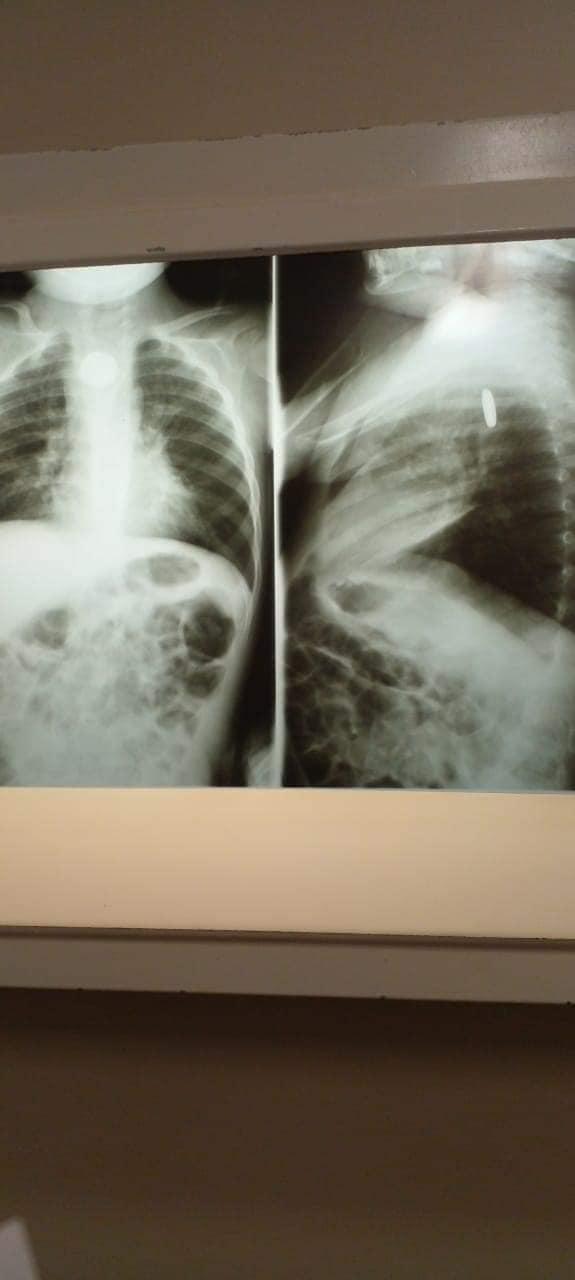 Medicii din Mexic s-au luptat două săptămâni să îl salveze