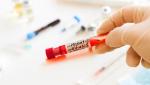 Adenovirusul care provoacă hepatita misterioasă la copii. Cercetătorii americani au descoperit posibila sursă a infecţiilor