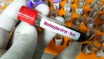 OMS transmite că variola maimuţei nu este o urgenţă sanitară globală