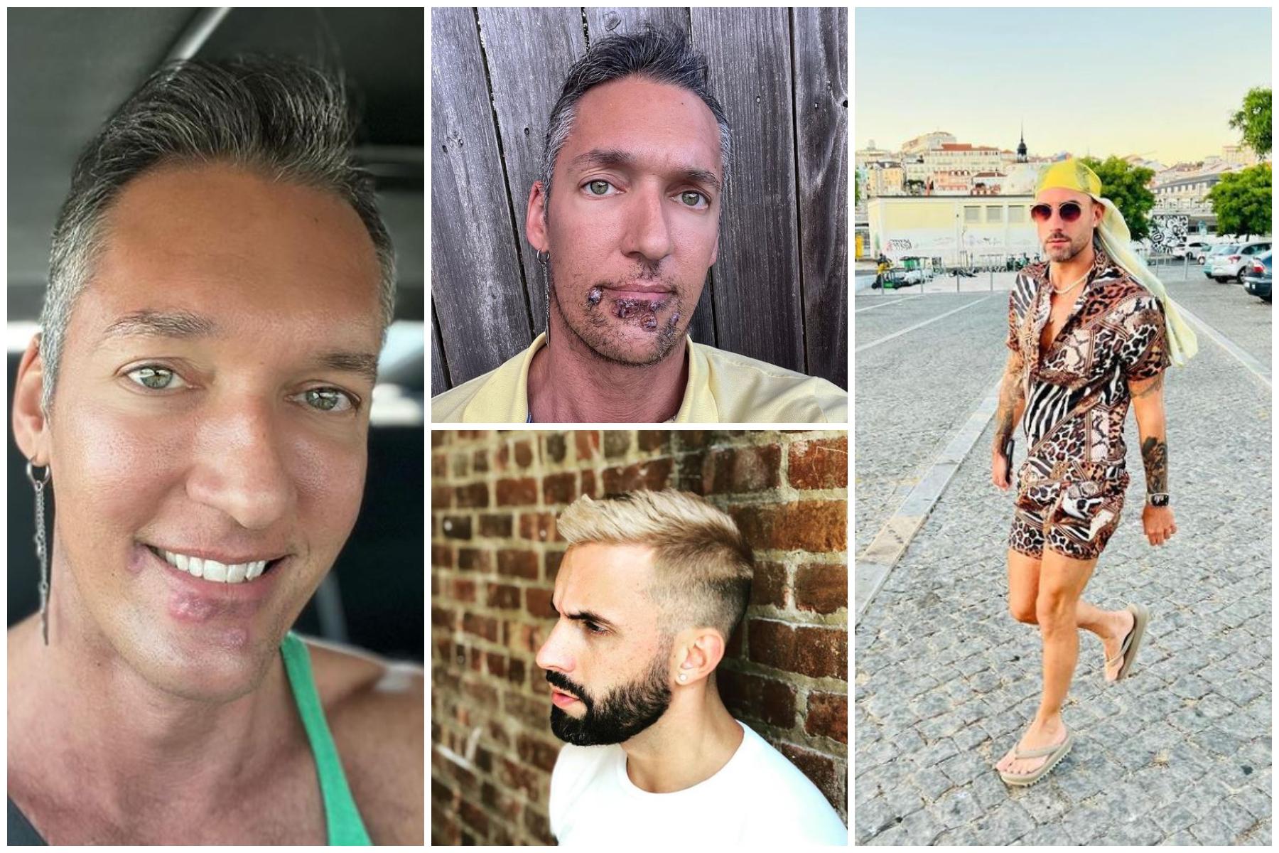 Mărturii ale pacienţilor infectaţi cu variola maimuţei