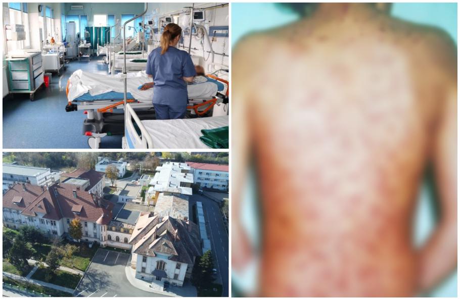 Băiat de 7 ani, internat cu o formă rară de varicelă Băiat de 7 ani, internat cu o formă rară de varicelă