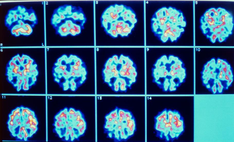 Primul caz de Alzheimer la un pacient tânăr: adolescentul a avut simptome de la 17 ani şi a fost nevoit să renunţe la şcoală Primul caz de Alzheimer la un pacient tânăr: adolescentul a avut simptome de la 17 ani şi a fost nevoit să renunţe la şcoală