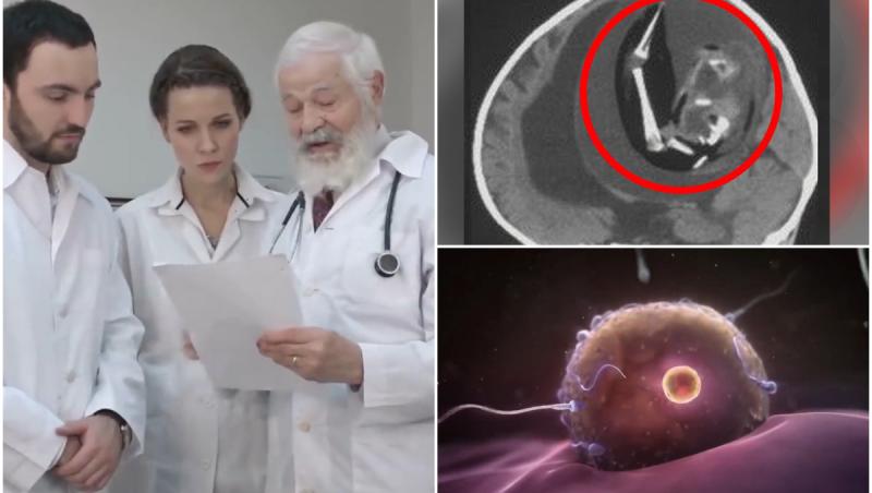 O fetiţă şi-a absorbit fratele în uter. Rămăşiţele lui îi presau pe creier, au descoperit medicii chinezi