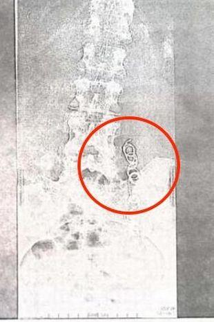 11 ani de chin. Motivul şocant pentru care o femeie din Columbia a trăit peste un deceniu cu dureri insuportabile. Care a fost greşeala medicilor