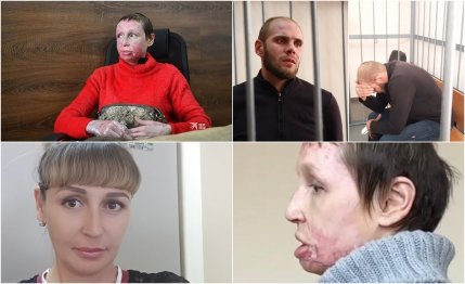 "A fumat o țigară și m-a privit cum ardeam". Femeie din Rusia, torturată de iubitul de care voia să se despartă. Bărbatul ar putea să scape de închisoare