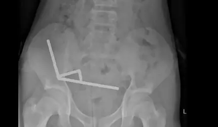 Un băiat de 13 ani din Noua Zeelandă a rămas fără o parte din intestin după ce a înghiţit zeci de magneţi