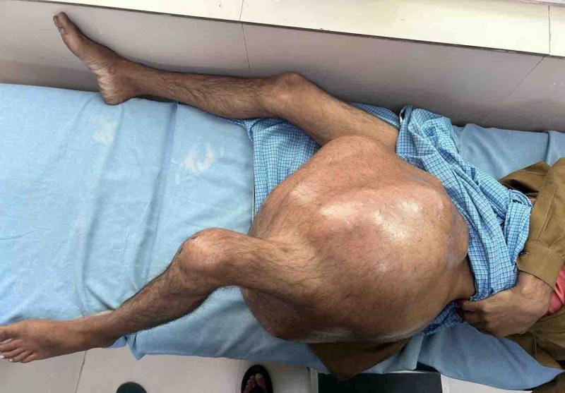 Tumoarea de 35 de kilograme Tumoarea de 35 de kilograme