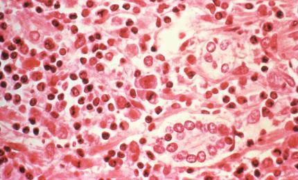 Hantavirus a ajuns în Europa. Un pasager care părăsise nava Hondius a fost testat pozitiv