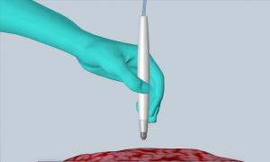 Invenție medicală REVOLUȚIONARĂ: o sondă de mărimea unui stilou poate detecta celulele canceroase în doar 10 secunde