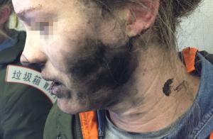 S-a trezit cu faţa ÎNNEGRITĂ şi mâinile ARSE! O australiancă a fost rănită după ce i-au explodat căştile în timpul unui zbor (FOTO)