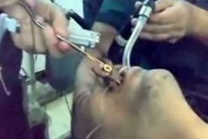 VIDEO INCREDIBIL! Ce au scos medicii irakieni din gura unui pacient
