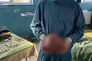 Tumoră gigantică extirpată de pe faţa unei paciente, într-o intervenţie medicală de excepţie, la Caransebeș