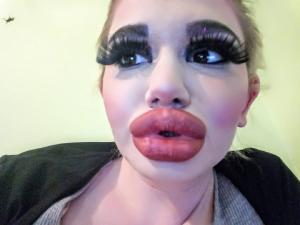 Andrea, o tânără din Bulgaria, vrea să obțină cele mai mari buze din lume