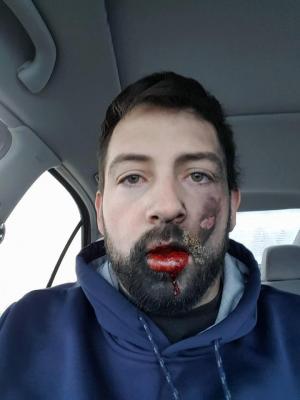 Bărbat mutilat de o țigară electronică. I-a explodat în față!