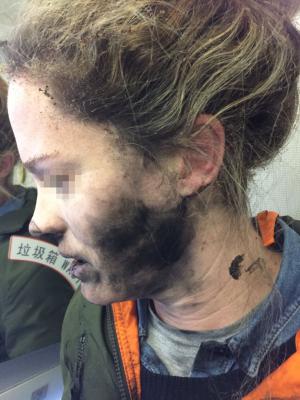 S-a trezit cu faţa ÎNNEGRITĂ şi mâinile ARSE! O australiancă a fost rănită după ce i-au explodat căştile în timpul unui zbor (FOTO)