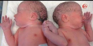 GEST EMOTIONANT: Doi gemeni s-au luat de mana, imediat dupa nastere