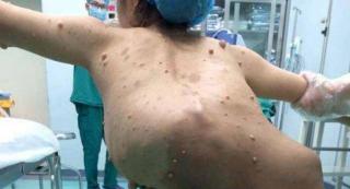 ÎNGROZITOR! Unei femei i-a fost extrasă o TUMORĂ de 25 de kilograme!