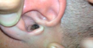 Nu mai rezista de durere! Ce i-au scos din ureche o să te scârbească