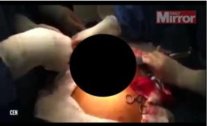 Video! Caz NEMAIÎNTÂLNIT! Medicii au scos un PEŞTE viu din STOMACUL unui bărbat