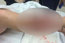 Imagine HORROR! Așa arată o MUȘCĂTURĂ DE RECHIN!