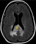 Efectele ÎNGRIJORĂTOARE ale lipsei somnului! Ce se întâmplă cu creierul